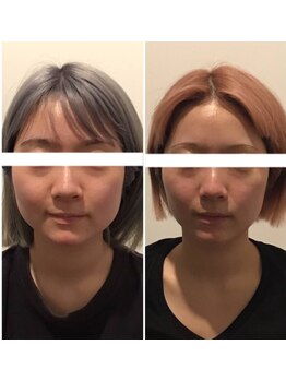 ルミナ(LUMINA)/小顔コルギ Before→After