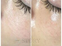 ストーリー 岐阜店(STORY)/ハーブピーリング専門店STORY