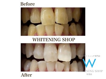 ホワイトニングショップ 甲賀店/Before&After『ホワイトニング』