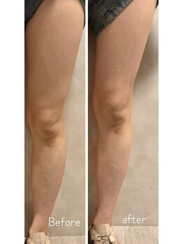 オーパーツ(OOPARTS)/血流ケア＋深温活でむくみ改善