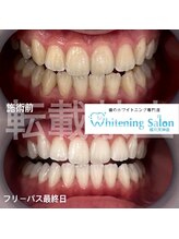 ホワイトニングサロン 福岡天神店/ホワイトニング