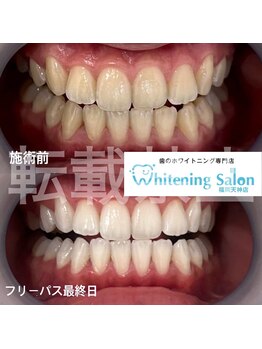 ホワイトニングサロン 福岡天神店/ホワイトニング