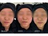 【最強小顔】お顔の脂肪を分解たるみの引き締めに!小顔効果◎