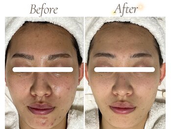 ミラリー(MIRALY)/くすみニキビケア4ヶ月(20代)