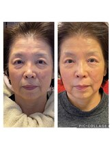 クレル(Clair)/70代お客様before→after