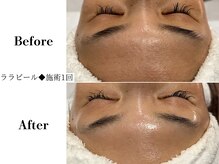 フレイヤ(FREYA)/ララピールBefore→After