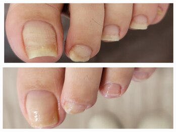 エーケーネイル(AKnail)/フットケア