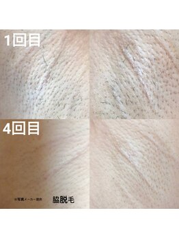 サロンドプッチイ(SalondoPutti)/【ハイブリッド】脇脱毛