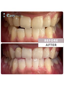イージーホワイトニング 五反田店(easy whitening)/セルフホワイトニング症例写真
