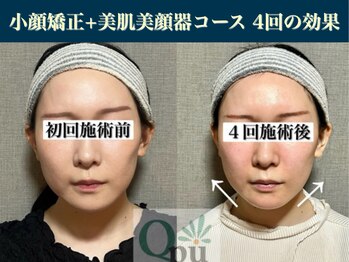 キュープ 表参道店(Qpu)/美顔器モニターコース4回の変化