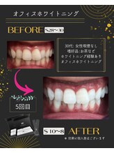 ホワイトニングプラス(Whitening+)/続けるとこの白さ