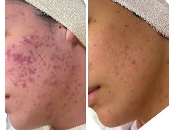 ハクビューティー(HAKU BEAUTY)/ニキビ改善でQOL向上