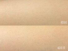 ウォーム(warm)/脱毛/顔脱毛/シェービング