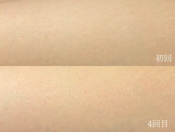 ウォーム(warm)/脱毛/顔脱毛/シェービング