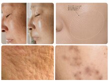 エスボーテ(sbeaute)の雰囲気（臍帯由来幹細胞培養上清液導入/本気のエイジングケア/凸凹赤み）