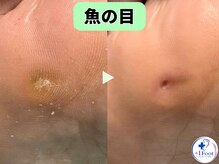 プラスワンフット 本厚木(+1 Foot)/タコ・魚の目ケア！痛みから解放
