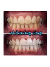 ホワイトニングショップ 所沢店/ホワイトニングショップ所沢店