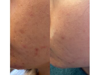 長寿鍼灸院 長寿整骨院/美容鍼25本の効果★肌質改善