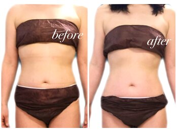 リリィブラン(Lily branc)/痩身上半身モニター様/お腹+腰