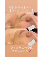 リノ(Lino)/陶肌肌トリートメント