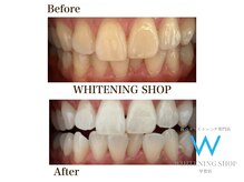 ホワイトニングショップ 甲賀店/Before&After『ホワイトニング』
