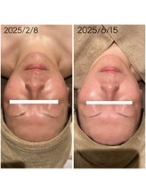 サロン リア(Salon Li’a)/限定☆最新シミケア2回☆