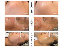 たるみ・シワ・くすみなどエイジングケア得意なサロンです！