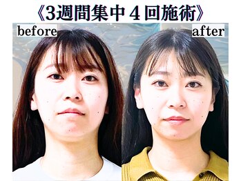 ボナボナ 仙台立町(BONA BONA)/結婚式まで二重アゴ改善したい!