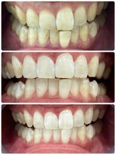 エクシアホワイトニング 日本橋店/ホワイトニングジェルには