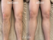リエラ(Liella)/【足脱毛】6回目