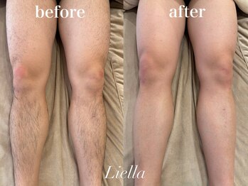 リエラ(Liella)/【足脱毛】6回目