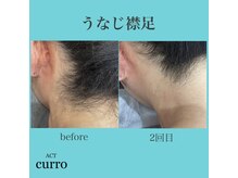 アクト クロ(ACT curro)/【うなじ襟足】脱毛施術例