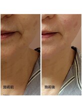 ムーモー 横浜関内店(mu_mo_)/糸リフト症例３