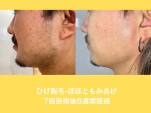 エクレ 柏店(EKURE)/ヒゲ脱毛