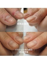 ニコプラス(NICO+)/深爪育成パラジェルクリア補強