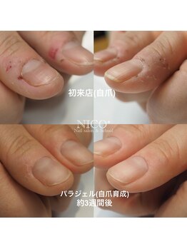 ニコプラス(NICO+)/深爪育成パラジェルクリア補強