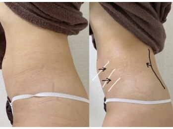 エクリル(Eclire)/くびれ/厚み