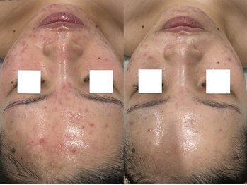 ジョアアンジェ 京橋店(joie ange)/肌質改善