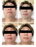 ☆初心者歓迎☆【メンズひげ脱毛】お忙しい方もスピーディーに◎