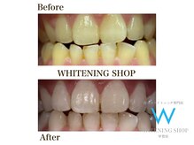 ホワイトニングショップ 甲賀店/Before&After『ホワイトニング』