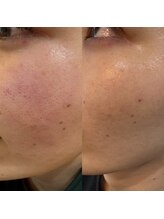 ビオラス(VIOLUS)/20代女性/毛穴ケア