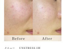 サロン ベルーチェ(SALON Belluce)/20代乾燥赤みにはアンストレス！