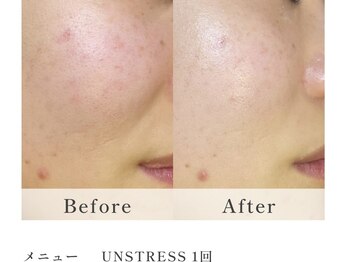 サロン ベルーチェ(SALON Belluce)/20代乾燥赤みにはアンストレス！