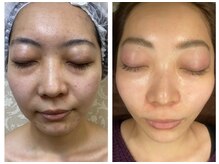 リアンボーテ(Lien Beaute)の雰囲気（【お客様の事例】ハーブピーリングの効果でツヤ肌になりました。）