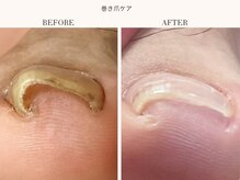 ディグニティ(Dignity)/巻き爪改善ケア