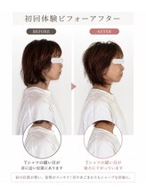 リフェイス(RE:FACE)/首後ろの盛り上がり改善