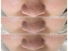 プラセル(Placer)の雰囲気（ハードなケアをしても変わらなかった毛穴。1年2ヶ月でここまで☆）