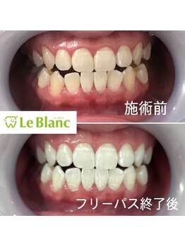 ルブラン 奈良店(Le Blanc)/【歯の色チェック】