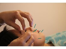 リマホオラシンキュウセイコツイン(lima ho ola鍼灸整骨院)/美容鍼+美整顔矯正