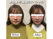 ハリカ 東京新宿店(HARIKA)/定番人気の美容鍼×小顔矯正